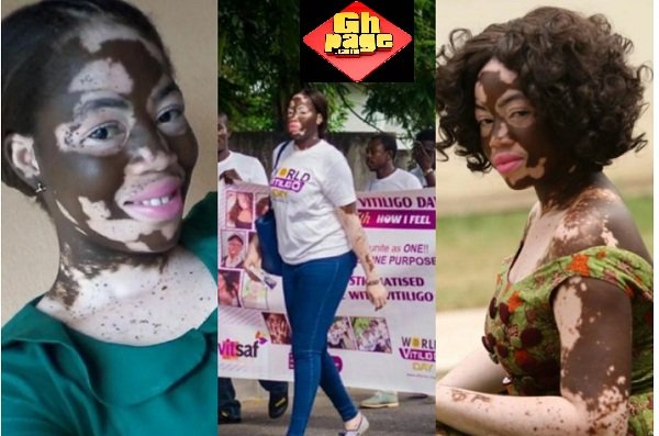 Ghanaian Nurse And Model With 'Rare' Skin Condition Fights Against Discrimination(Photos)