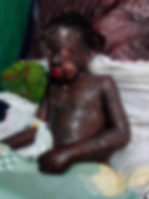 Emmanuel Ameyaw after Stevens-Johnson syndrome