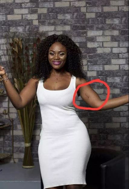 Below is how she looks now and the spot on her arm kind of point to the fact that she undergone a liposuction: