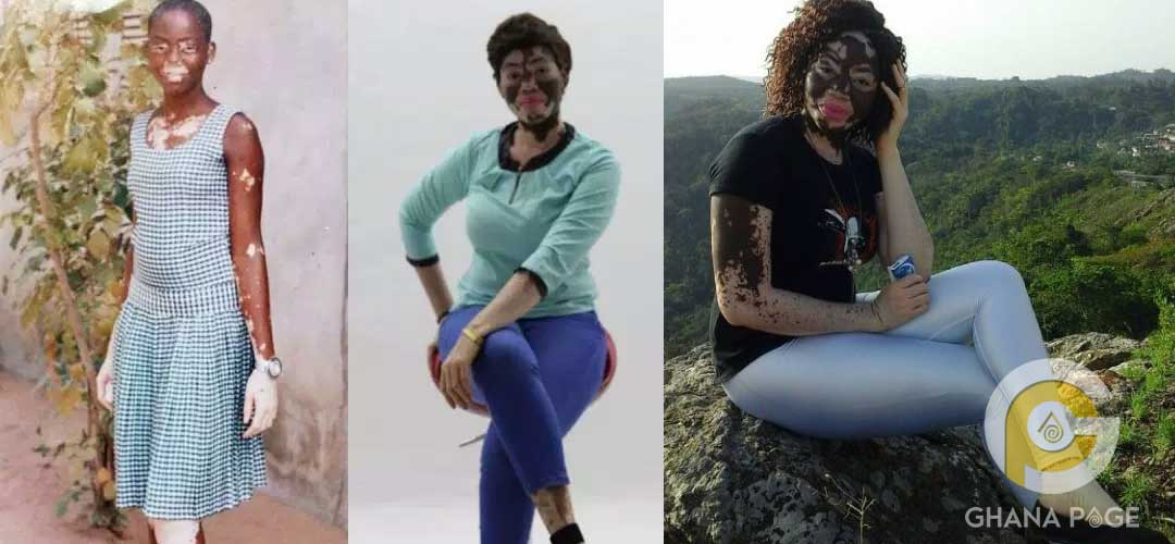 Ghanaian nurse with Vitiligo goes viral with her #10years challenge