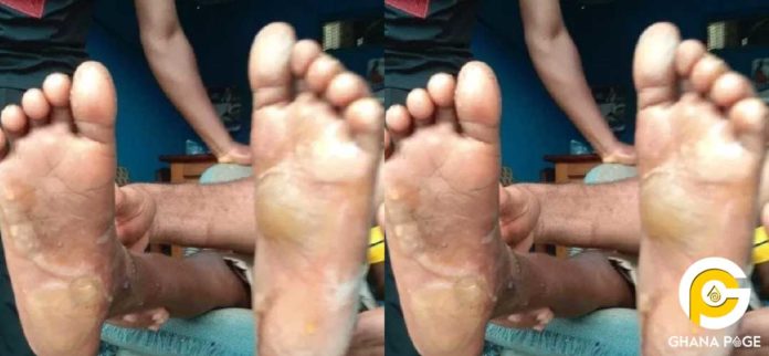Man arrested for burning the feet of his son for allegedly eating his stew