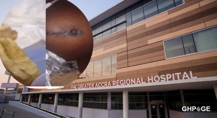 Ridge-Hospital-doctor-left-towel-in-a-woman’s-stomach-for-9-months-after-C-section