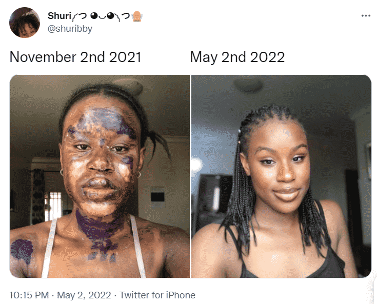 Gas explosion survivor