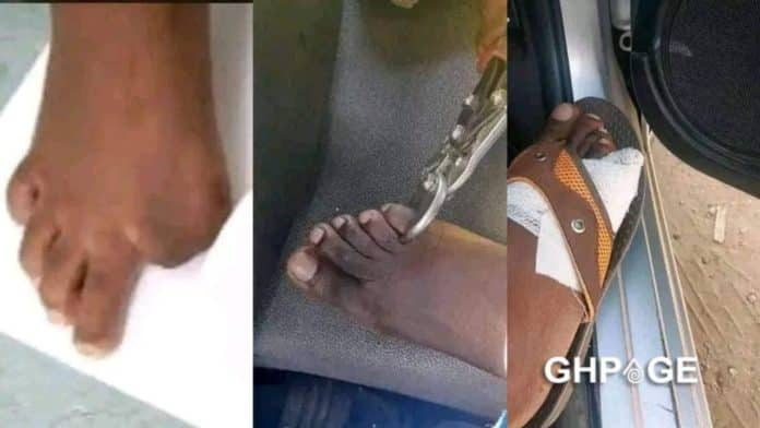 Zimbabweans start selling their toes for money to survive