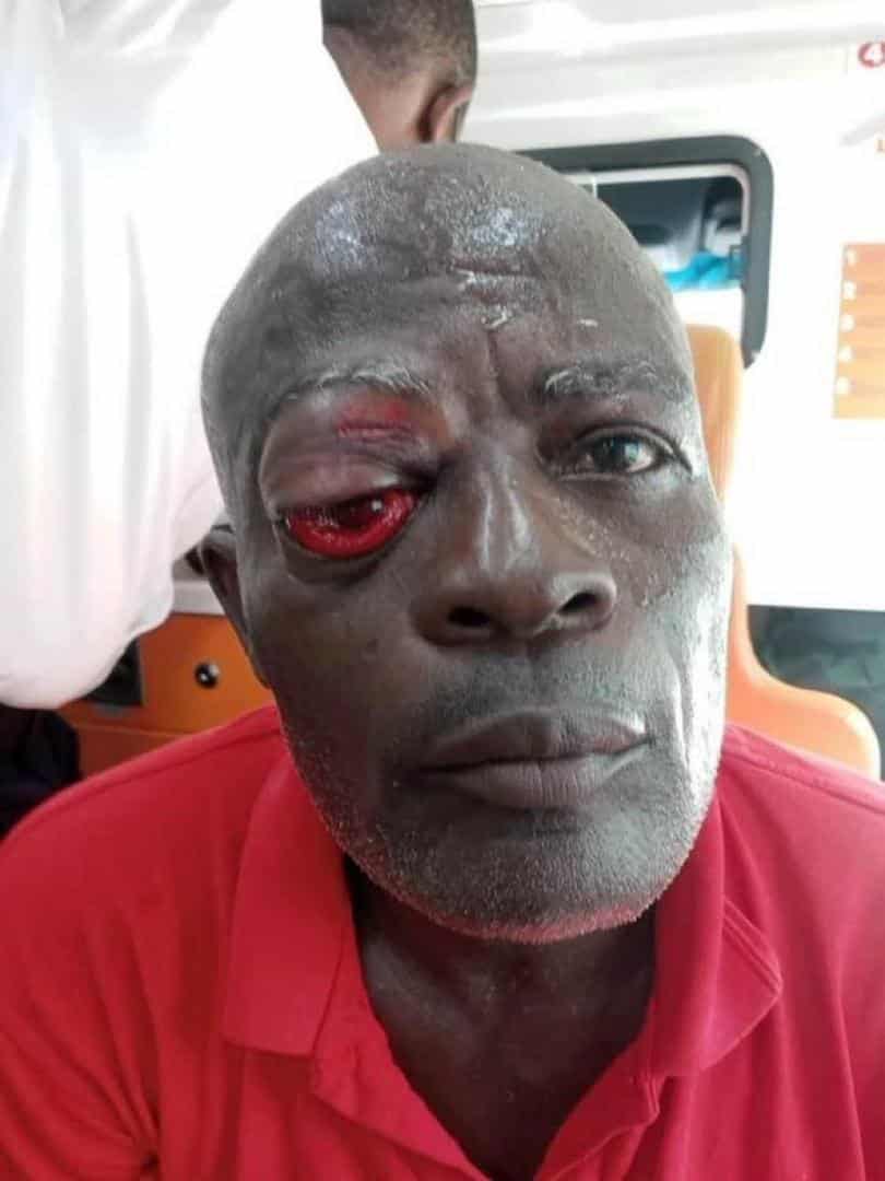 Arise-Ghana-protester-hit-by-a-rubber-bullet-in-the-right-eye