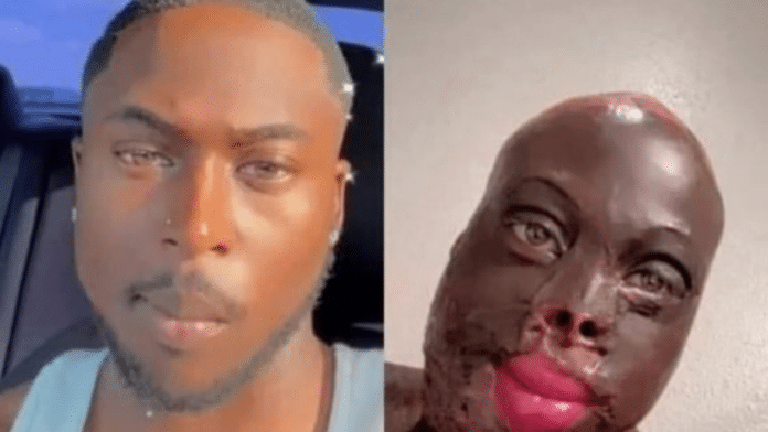 Lady ruins her boyfriend's face with acid for allegedly cheating on her