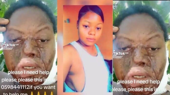 Boyfriend pours acid on his beautiful girlfriend for allegedly cheating on him
