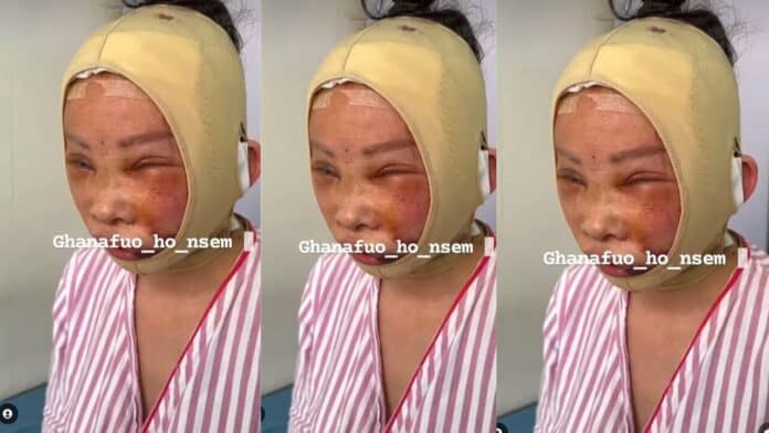 Facelift gone wrong as GH lady ends up looking like a beaten boxer - Video